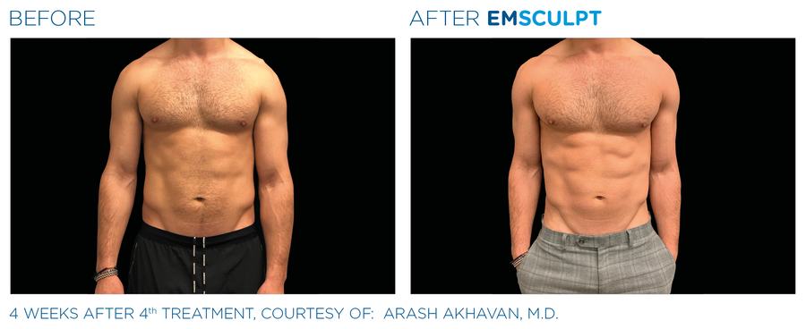 Emsculpt_PIC_Ba-card-male-abdomen-108_ENUS100