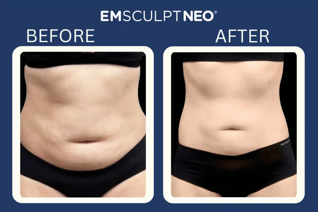 emsculpt-before-and-after-emerson-nj