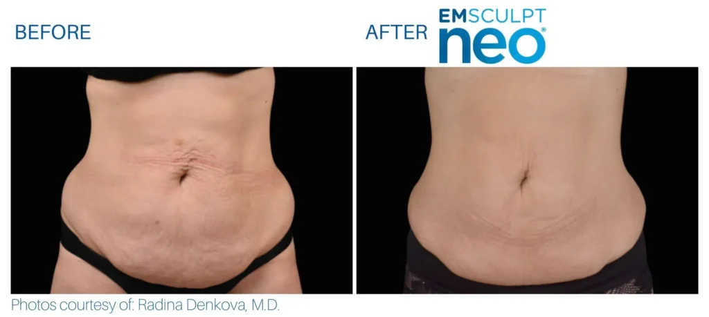 emsculpt_neo_before_and_after_pics_juliaedelmanmd_13.jpg