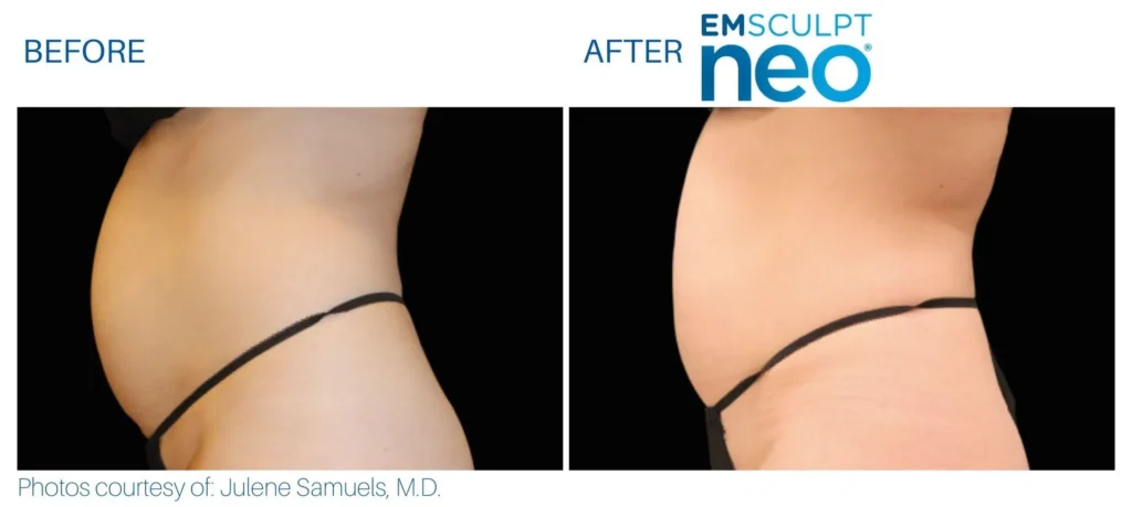 emsculpt_neo_before_and_after_pics_juliaedelmanmd_7.jpg
