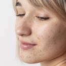 close-up-woman-with-acne-posing